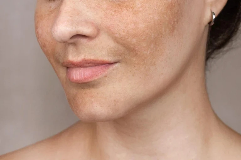 Pigmentation Clinic Singapore: Understanding Deep Dermal Pigmentation vs Surface Pigmentation